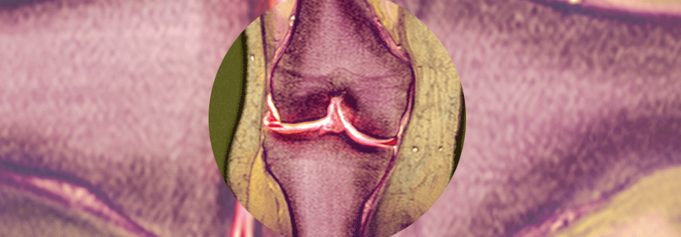 Rechtes Kniegelenk einer 52-Jährigen mit Riss im Außenmeniskus (kleine rote Stellen, Mitte links).