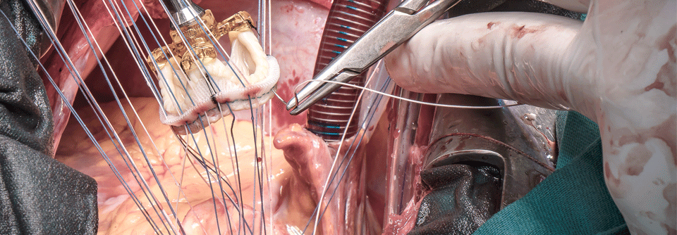 Unter 75-Jährige mit niedrigem OP-Risiko sollten einen chirurgischen Aortenklappenersatz erhalten.
