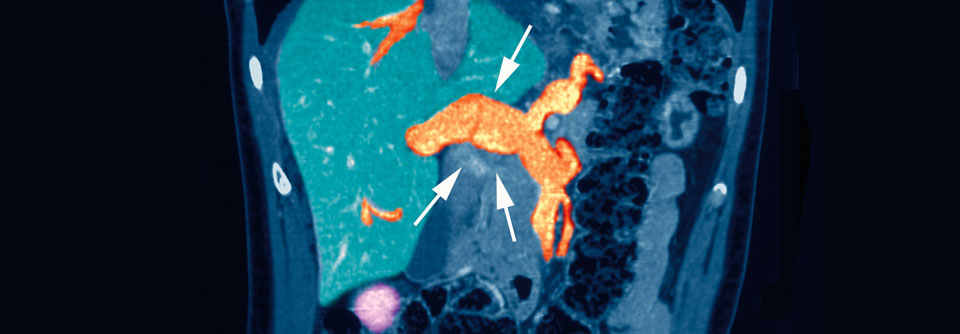 Pfortaderthrombose bei einem 25-jährigen Patienten. Die CT ist notwendig, um die genaue Ausbreitung des Gerinnsels zu erfassen und eine Darmischämie auszuschließen.