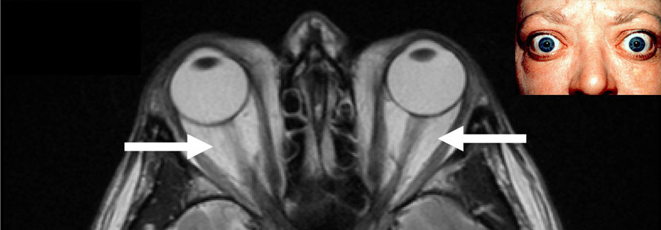 Klinisch äußert sich die endokrine Orbitopathie durch deutlich hervorgetretene Augen.