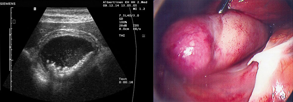 Sprechen Klinik und Sonographiebefund für eine akute Cholezystitis, ist die Resektion der Gallenblase Standard. Doch nicht alle Patienten sind operabel.