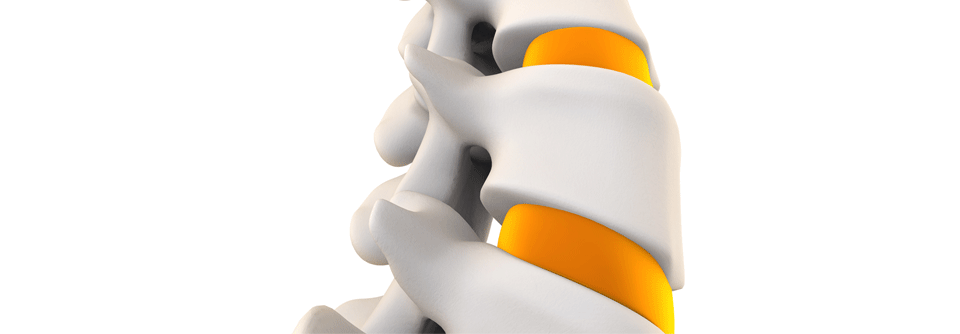 Patienten mit Spondylodiszitis sind in vielerlei Hinsicht gefährdet.