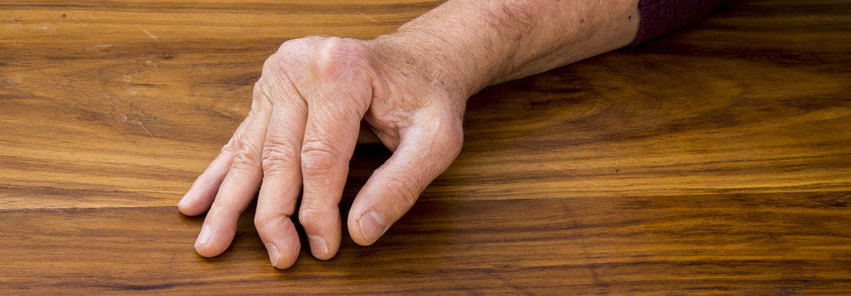 Bei Menschen mit Psoriasisarthritis treten signifikant weniger Infektionen auf.