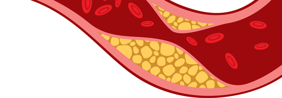 Im Verbund mit Lebensstiländerungen können schon pflanzliche Arzneien Wirkung bei leicht erhöhtem Cholesterinspiegel zeigen.