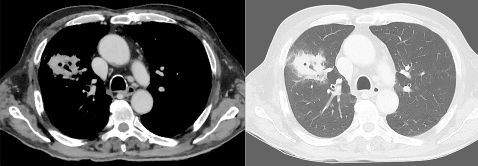 Im CT-Bild zeigt sich bei einem 67-Jährigen beidseits eine pulmonale Aktinomykose mit Kavernenbildung und Pleuraempyem.