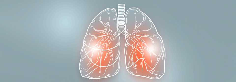 Eine Liquid Biopsy hilft, das Ansprechen auf den MET-Inhibitor zu definieren.