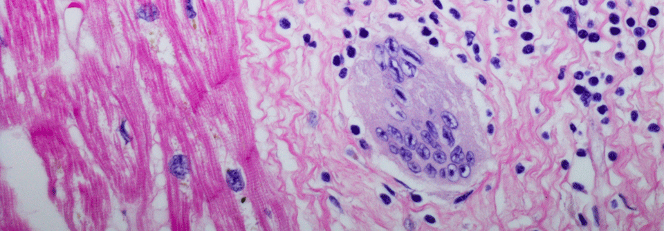 Nur etwa 25% der Fälle sind histologisch eindeutig, daher hat die Biopsie bei der Diagnose der kardialen Sarkoidose keinen hohen Stellenwert.