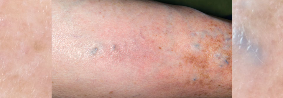 Thrombophlebitis superficialis am Bein einer 82-jährigen Patientin.