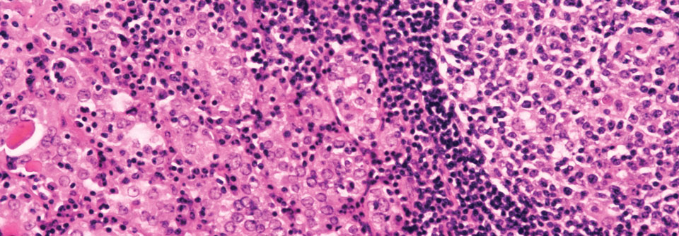 In der Schilddrüse eines Hashimotopatienten hat sich ein Keimzentrum (rechts) gebildet. Die dort produzierten Lymphozyten greifen das körpereigene Gewebe an.