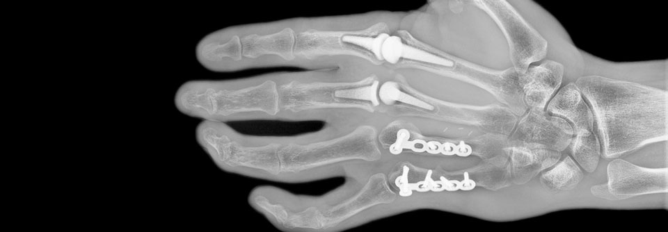 Dieser Patient hat einen operativen Gelenkersatz der MCP-Gelenke an Zeige- und Mittelfinger erhalten.