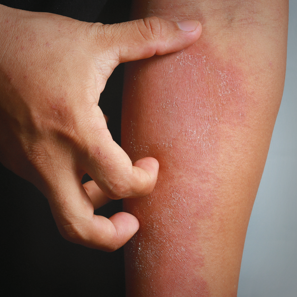 Atopische Dermatitis