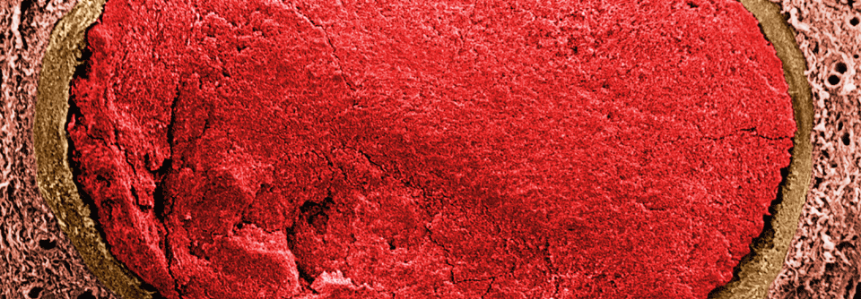 Großer Thrombus in einer Arterie: Präparat einer menschlichen Lunge im Rasterelektronenmikroskop.