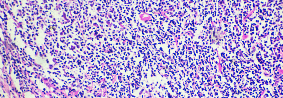 CAR-T-Zellen und Antikörper-Wirkstoff-Konjugate werden bereits für das Hodgkin-Lymphom erprobt.