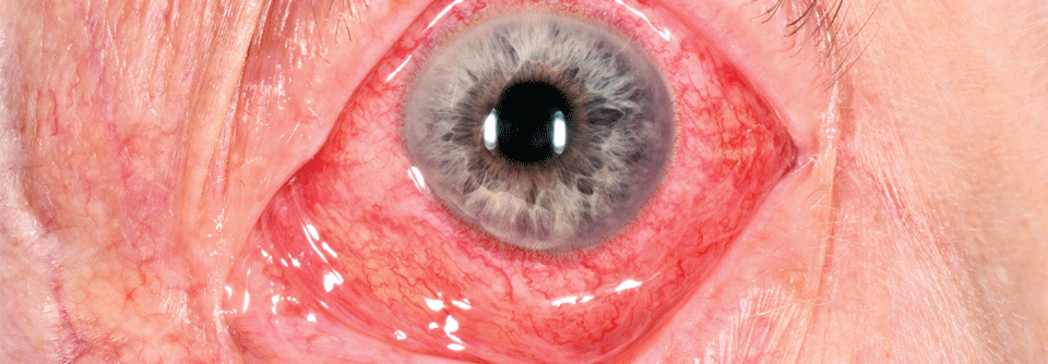 Neben Infektionen und Immuntherapie können u.a. Metastasen eine Uveitis auslösen. Es gilt daher, die Ursache abzuklären.