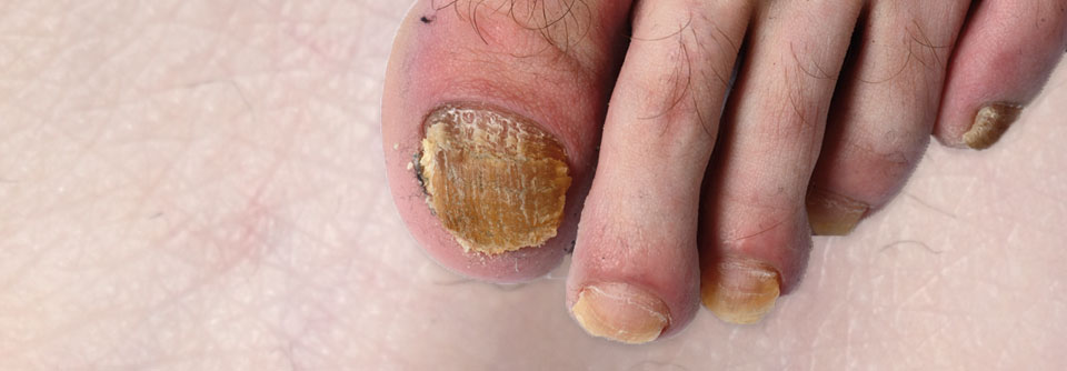 Die Nagelpsoriasis gehört bei der Schuppenflechte zu den Risikofaktoren für eine Gelenkbeteiligung.