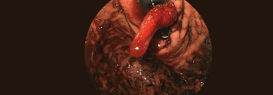 Cardia-Koagel bei einem Patienten mit Mallory-Weiss-Syndrom.