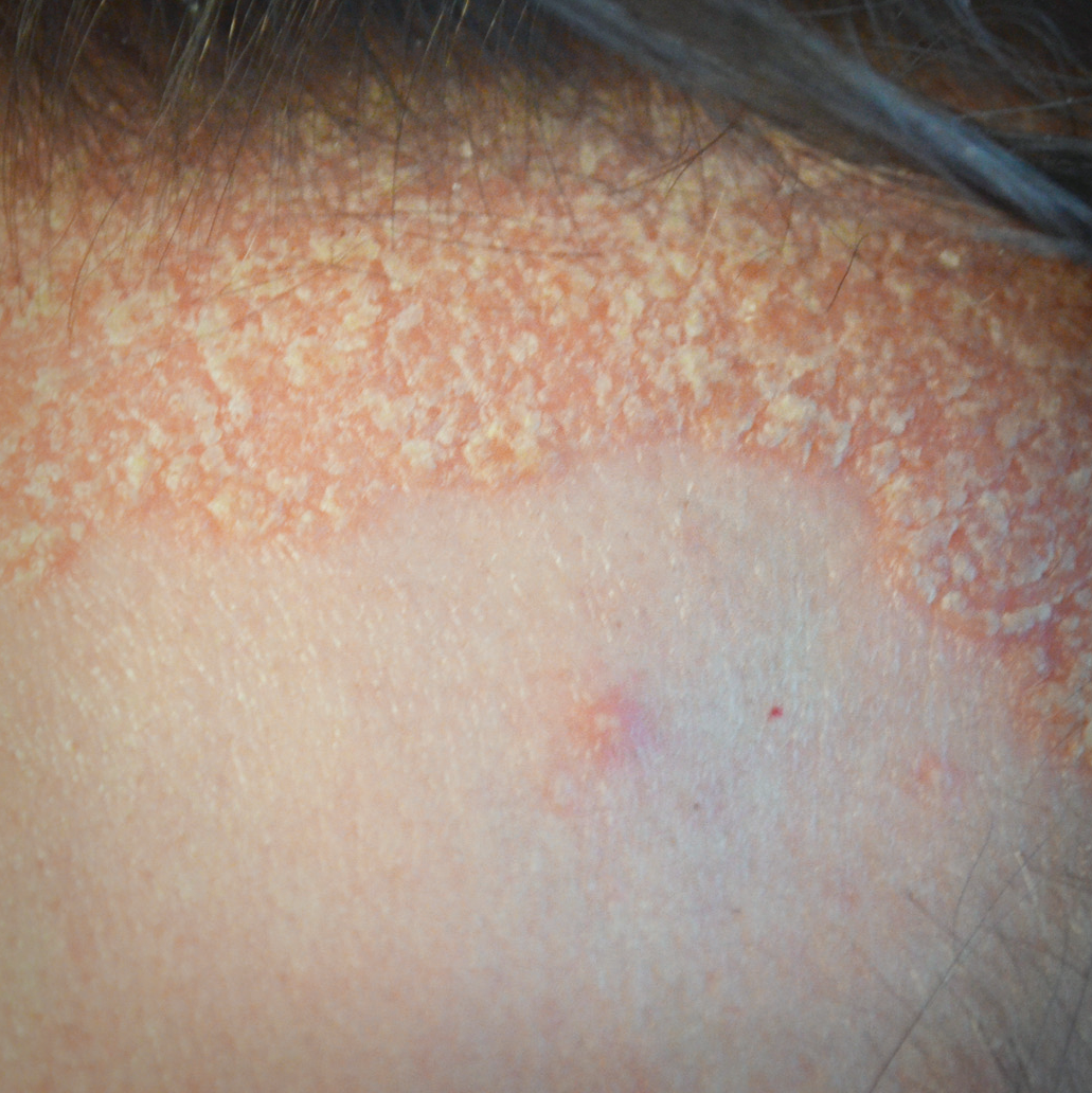 Psoriasis