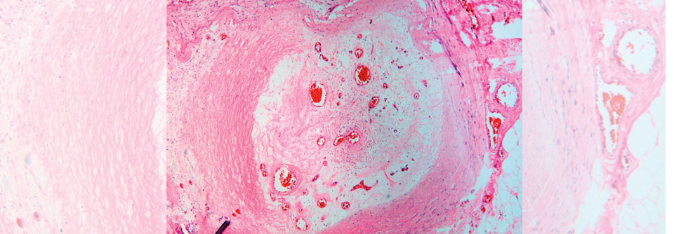 In diesem Fall kam es bei einem Patienten mit PAVK zum Verschluss einer Unterschenkelarterie. Zu erkennen ist ein bereits organisierter Thrombus im Lumen und die „alte“ Gefäßwand.