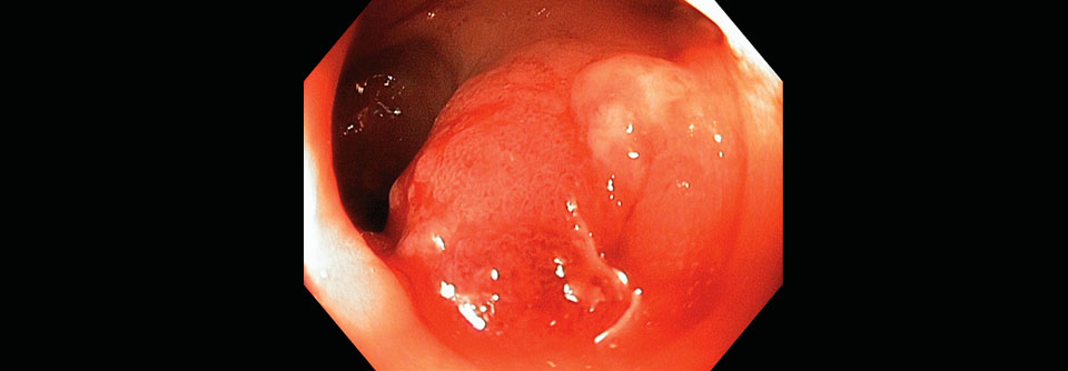 Bei Patienten mit Divertikulitis des Colon sigmoideum kann bei der Abdomenpalpation ein druckempfindliches und eventuell ­aufgetriebenes Sigma imponieren.