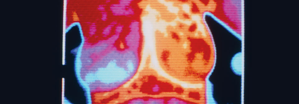 Studien legen nahe, dass die Remissionsraten bei metastasiertem Brustkrebs unter endokriner Therapie bis zu 30 % erreichen.