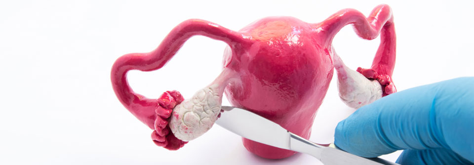 Mit dem Uterus gleich die Eileiter und Ovarien raus?
Bei jüngeren Frauen vor der Menopause sollte gut überlegt sein wo der "cut" gemacht wird.