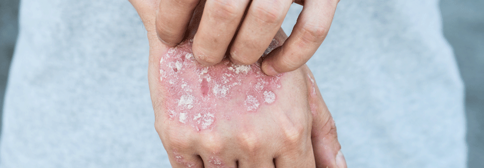 An Psoriasis Erkrankte sprechen schlechter auf eine systemische Therapie an, wenn sie dauerhaft einem übermäßigen Ethanol-„Genuss“ frönen.