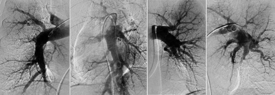 Anders als hier ist der Befund der CT-Pulmonalisangiographie manchmal auch unauffällig.