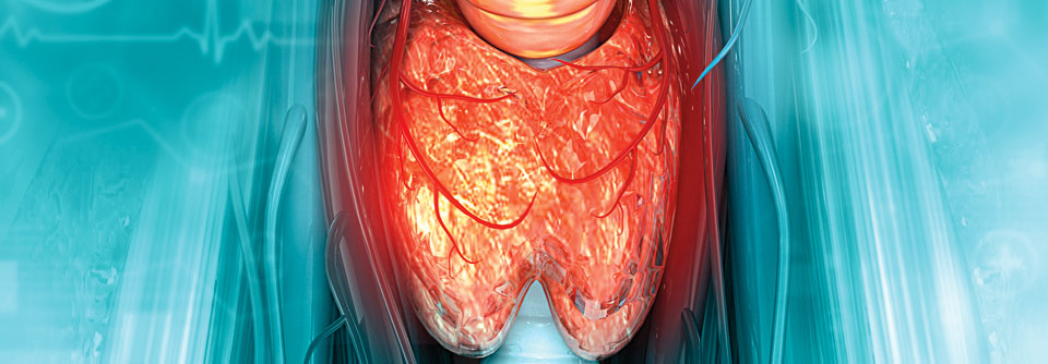 Gut 25 % der Menschen mit Typ-1-Diabetes weisen Thyreosen auf.