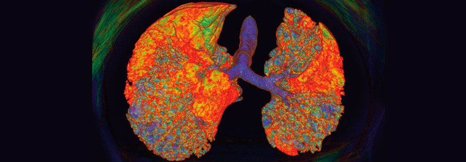 3D-Computertomographie eines Patienten mit interstitieller Lungenerkrankung.