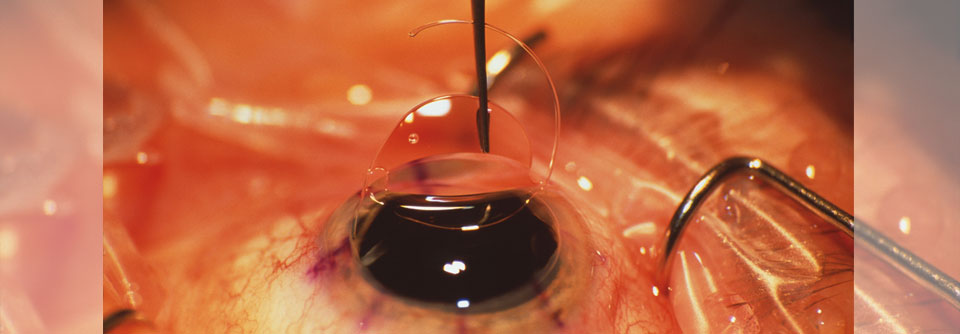 Ein Linsenaustausch an beiden Augen erfolgt meist zweizeitig und in Lokalanästhesie.