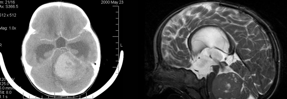 Medulloblastome treten bevorzugt im Kleinkindes- und Kindesalter auf undsind in dieser Altersgruppe die häufigsten bösartigen Hirntumore.