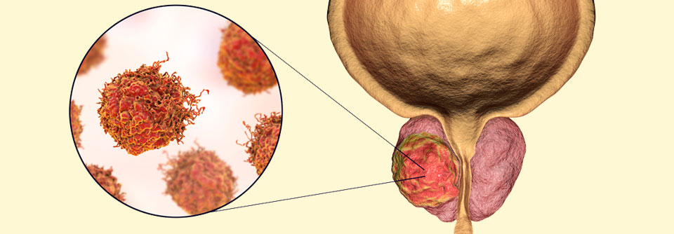 Auch beim metastasierten Prostatakrebs hilft es zu wissen, um welchen Tumortyp es sich handelt.