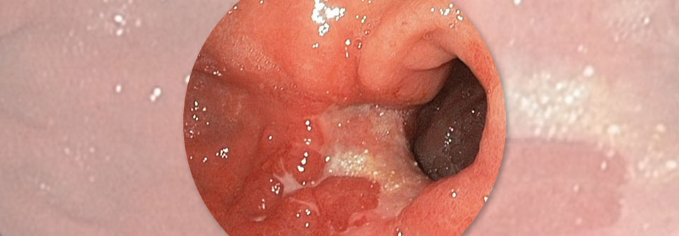 Adjuvante Chemotherapie für sensitive Magenkarzinome
Bei Stadium II muss die Muscularis propria infiltriert sein, bei Stadium III die Subserosa.