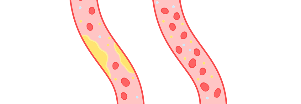Um die LDL-C-Zielwerte zu erreichen, ist unter Umständen der Einsatz von Kombinationstherapien sinnvoll.