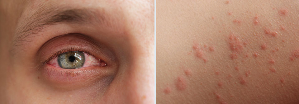 Allergische Konjunktivitis (links) als Reaktion auf Pollen oder Rauch bei Vorliegen einer Cannabisallergie. Auch eine Kontaktdermatitis (rechts) nach dem Hantieren mit Blättern oder Blüten ist möglich.