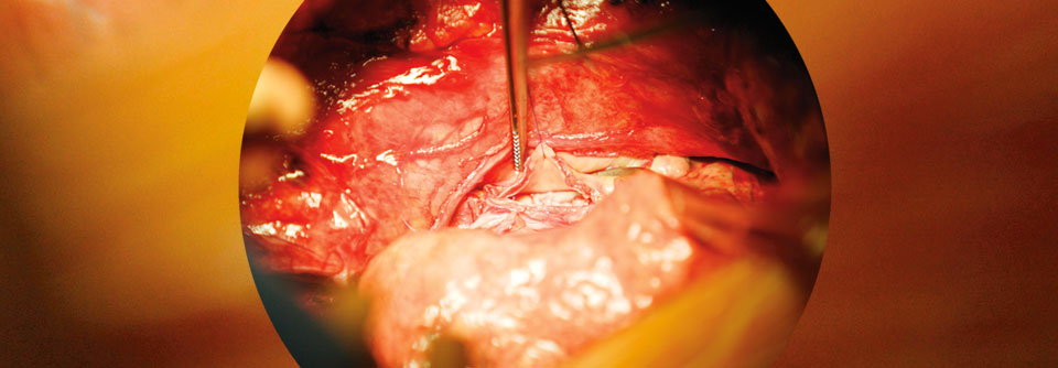 Bei Non-CF-Bronchiektasen gilt die ­Lungentransplantation als Ultima Ratio.