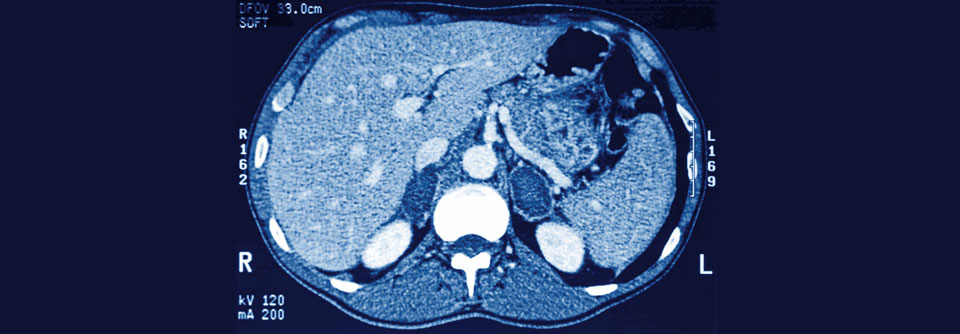 Häufig handelt es sich bei den Nebenniereninzidentalomen um eine benigne Neoplasie, wie hier im Bild. Es muss allerdings nicht ­immer so sein.