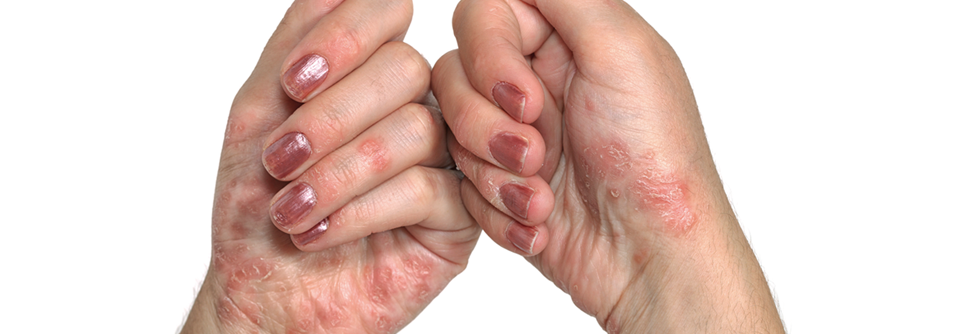 An den Händen der Patientin zeigen sich für die Psoriasis typische Hautveränderungen.
