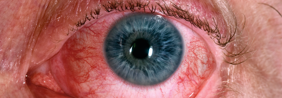 Meist ist eine Uveitis mit einer Autoimmunerkrankung assoziiert. Bei MS-Patienten liegt häufig der intermediäre Typ vor, bei dem es zu einer Entzündung im Bereich des Glaskörpers kommt.