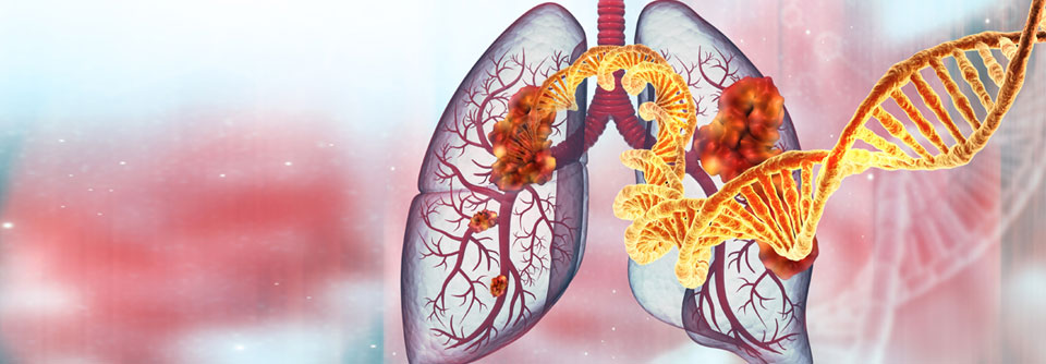 Lungenkrebs steckt in den Genen.