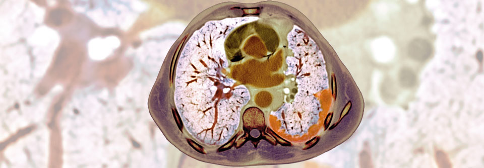 Inoperables Mesotheliom: Kombinierte Checkpoint-Inhibition schlägt Chemotherapie
Das Thorax-CT eines 69 Jahre alten Patienten mit Mesotheliom (orange).