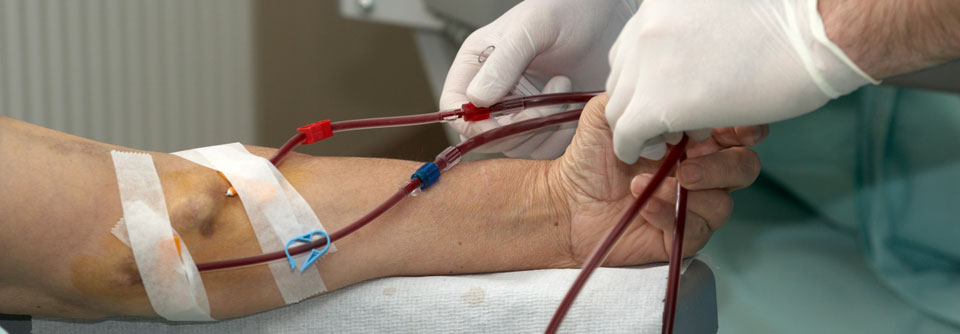 Nierenversagen: Sofort Blutdruck runter beim sklerodermiebedingten Organkollaps
Am besten sollte man dafür sorgen, dass es gar nicht erst zu einer langfristigen Nierenersatztherapie kommt.