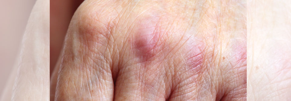 Flache, rötlich-livide Papeln und Plaques unterschiedlicher Größe auf den Streckseiten von Händen und Fingern. Diese Gottron-Papeln sind typisch für die Dermatomyositis und kommen sowohl bei Erwachsenen als auch bei Kindern vor.