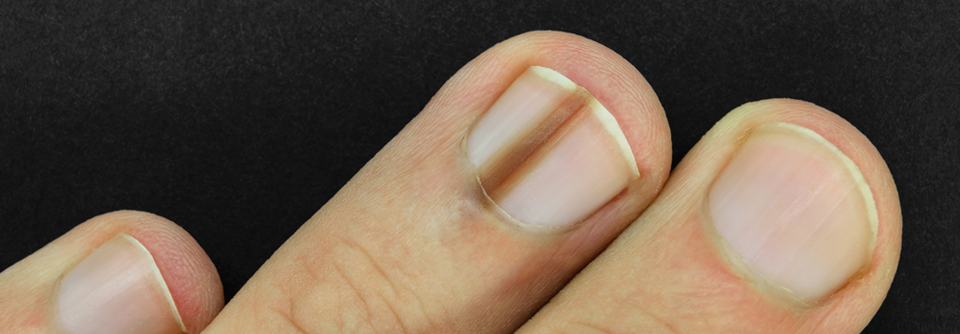 Nagelmelanom: Frühe Diagnose, adäquate Biopsie und effektive Entfernung Melanonychien können durch ein Nagelmelanom entstehen, daher sollte man unbedingt genau hinschauen.