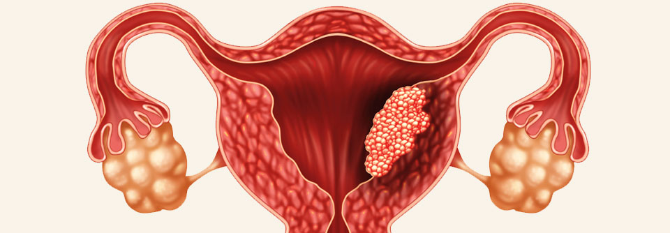 Was tun, wenn der Endometriumkrebs zurück kommt?