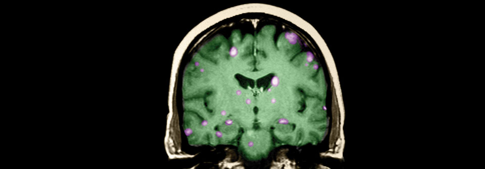 Zerebrale Metastasen verschlechtern die Prognose und die Lebensqualität Betroffener.