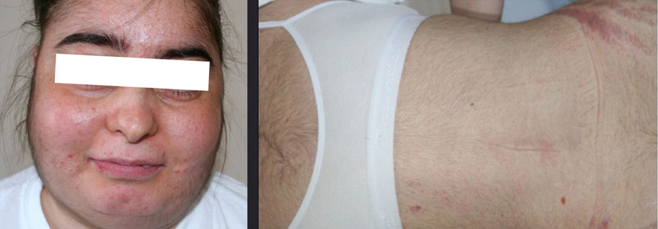 Cushing-Syndrom: Bei endogener Form ist lebenslange Nachsorge vonnöten
Zu den Symptomen des Cushing-Syndroms zählen unter anderem eine rundere Gesichtsform, Hirsutismus und livide Striae.