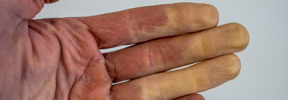 Typischerweise führt der Raynaud zunächst zu einer Weißfärbung der Haut.