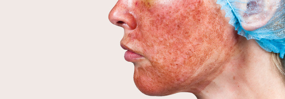 Chemisches Peeling als Option bei Akne, Falten und anderen Hautproblemen Bei dieser Frau wurde ein TCA-Peeling durchgeführt. Die Haut wird sich in ein paar Tagen regeneriert haben.
