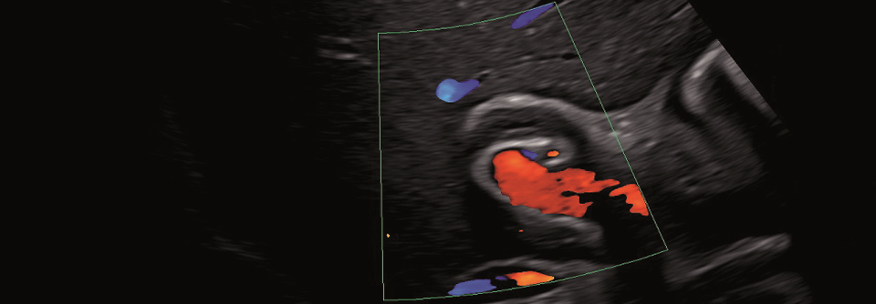 Wandverdickter Ductus hepatocholedochus bei primär sklerosierender Cholangitis.
